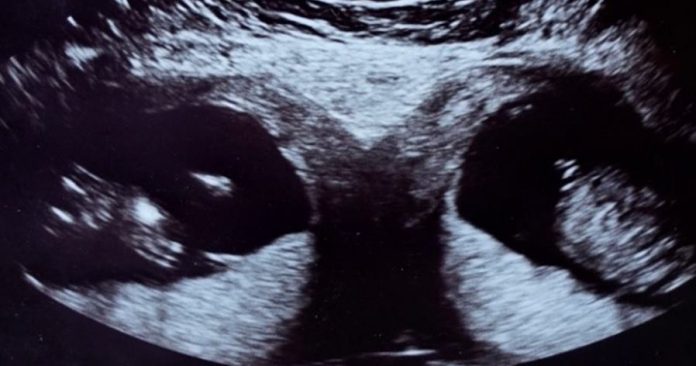 女天生有「双子宫」 两个都怀孕同时生下两个孩子