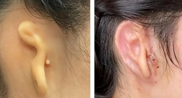 首用病人自体细胞 培植耳朵供移植